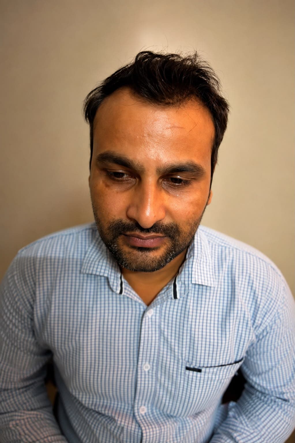 Patient before hair restoration