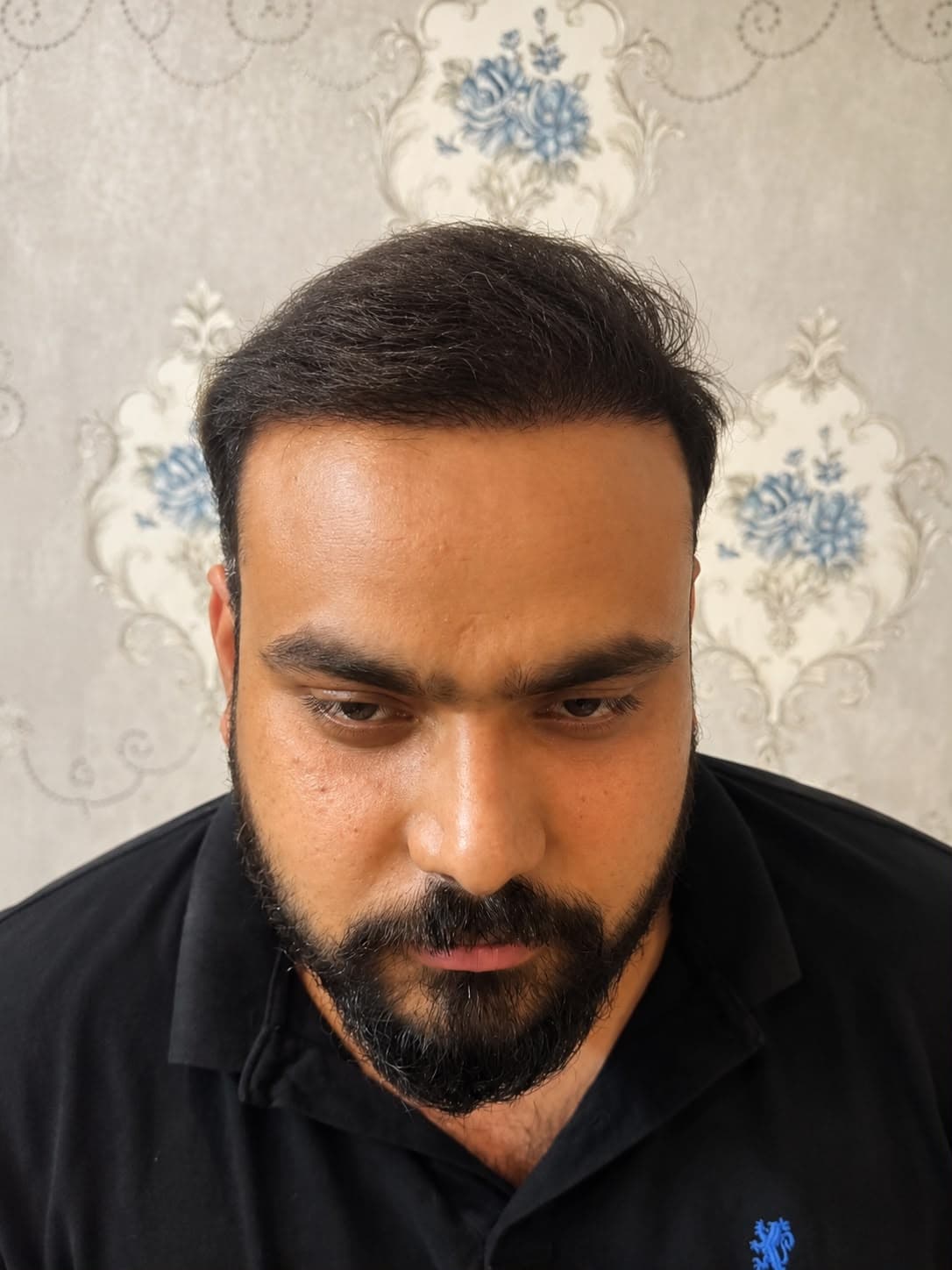 Reclaim your hairline. Restore your confidence. after