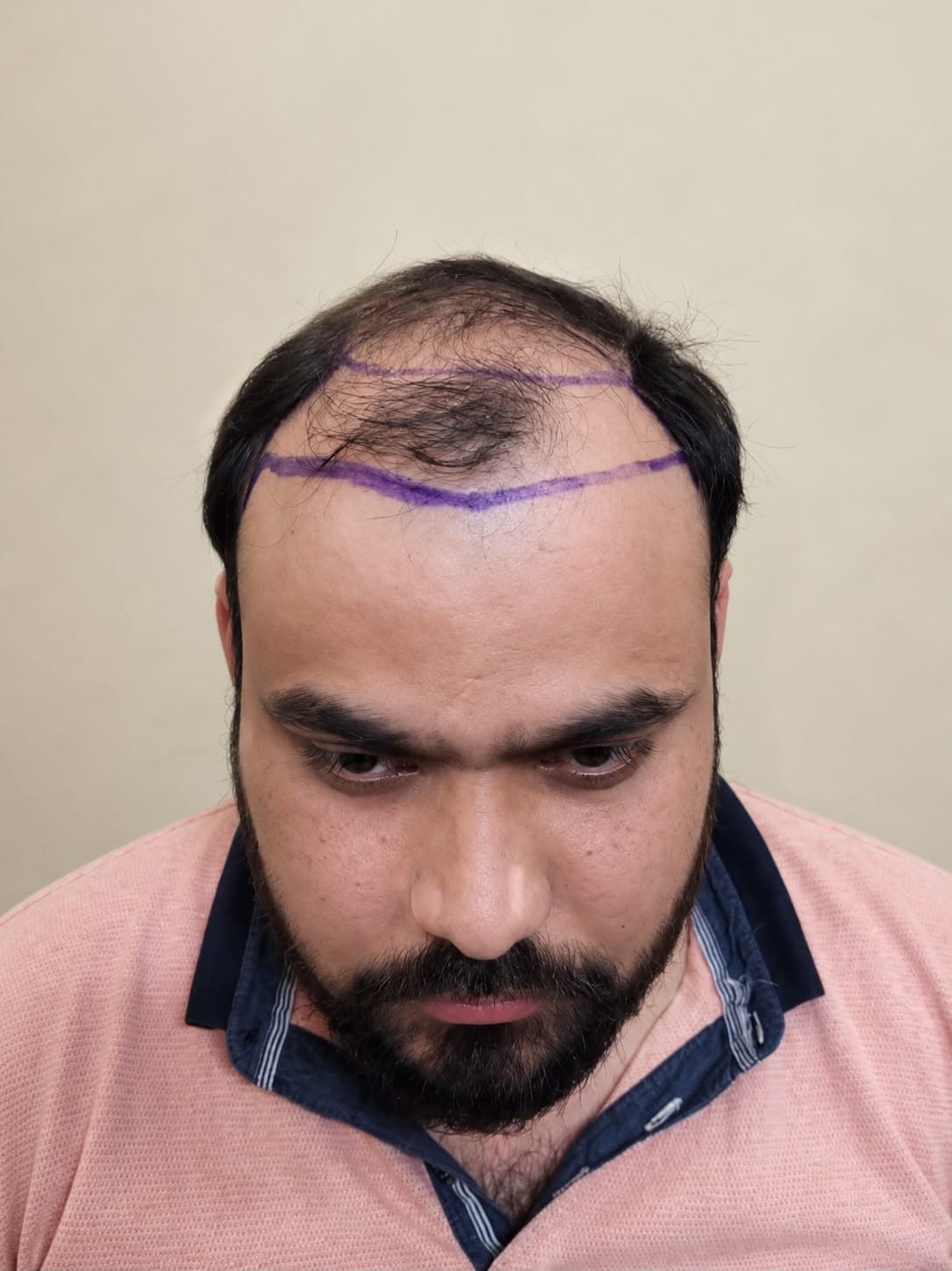 Reclaim your hairline. Restore your confidence. before