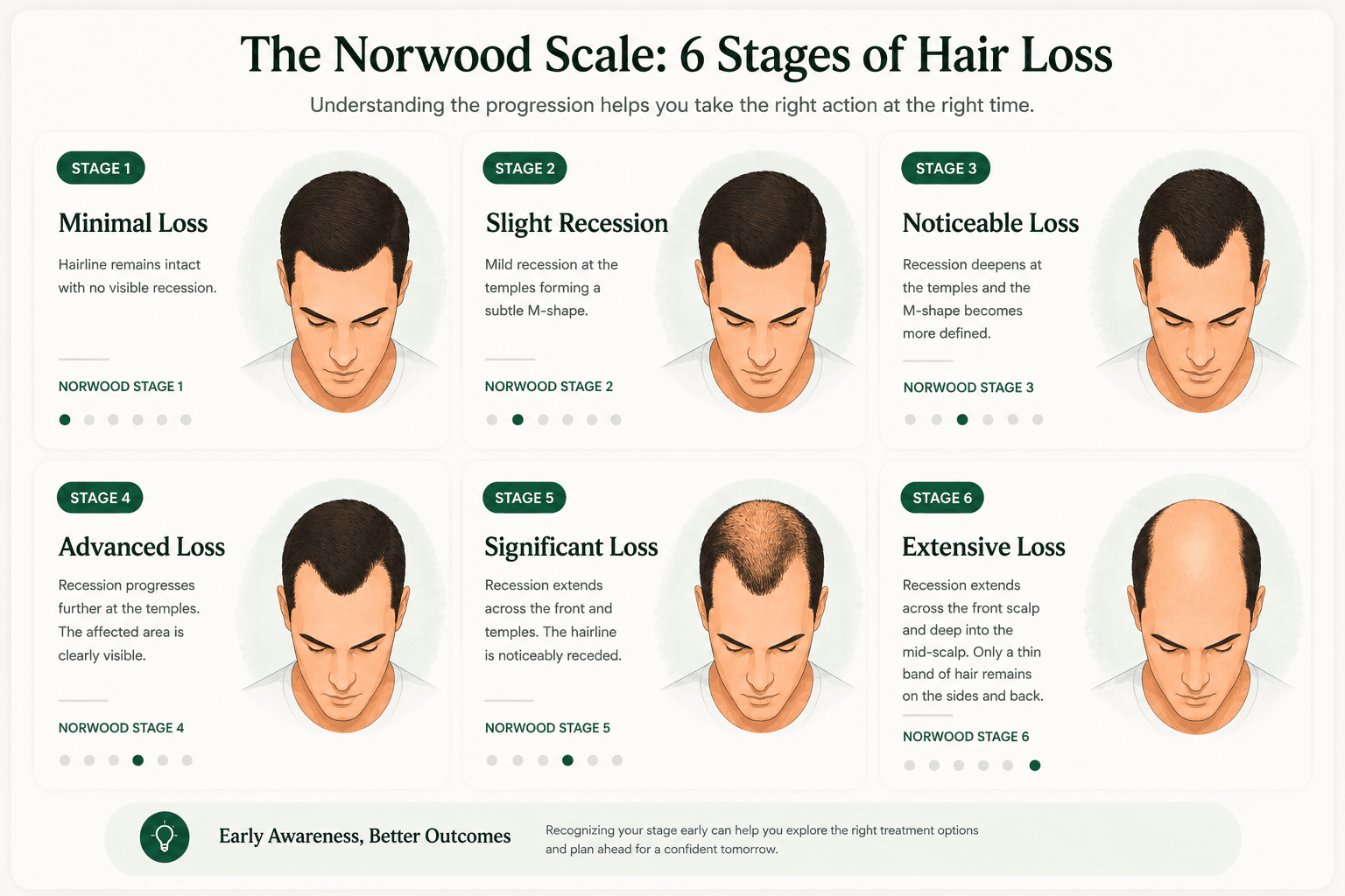 The six common Norwood hair-loss stages